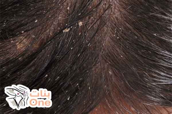 أضرار قشرة الشعر وأسبابها وطرق الوقاية منها  